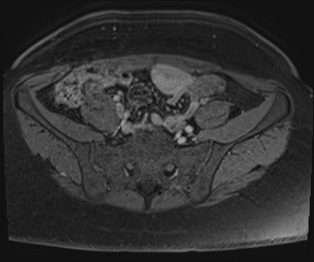 File:Class II Mullerian duct anomaly- unicornuate uterus with rudimentary horn and non-communicating cavity (Radiopaedia 39441-41755 Axial T1 fat sat 4).jpg
