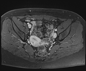 File:Class II Mullerian duct anomaly- unicornuate uterus with rudimentary horn and non-communicating cavity (Radiopaedia 39441-41755 Axial T1 fat sat 56).jpg