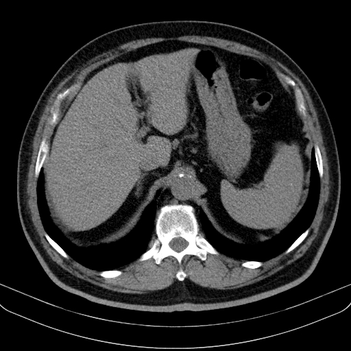 File:Classic complicated silicosis (Radiopaedia 49720-54961 Axial liver window 53).jpg