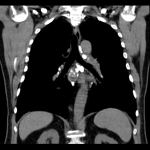 File:Classic complicated silicosis (Radiopaedia 49720-54961 Coronal liver window 37).jpg