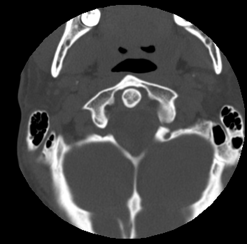 Clay-shoveler fracture (Radiopaedia 22568-22590 Axial bone window 7).jpg