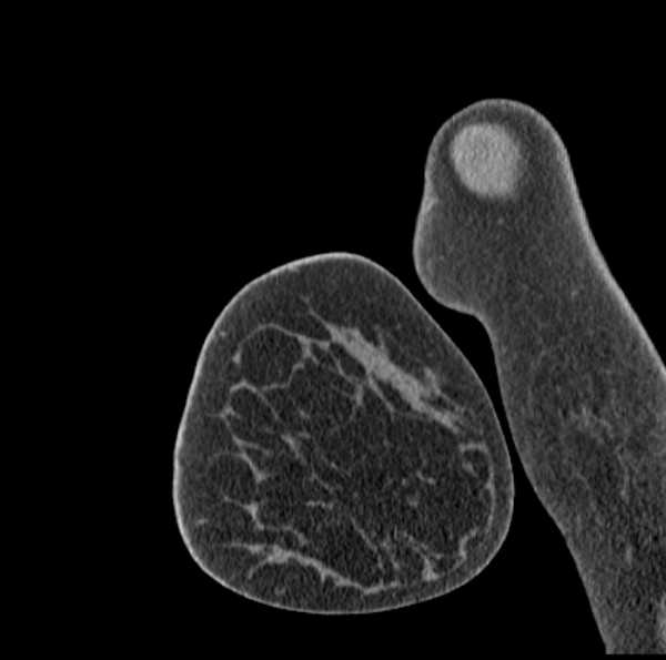 Clear cell chondrosarcoma - humerus (Radiopaedia 63104-71612 D 4).jpg
