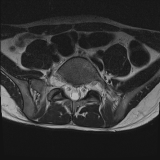 File:Clear cell meningoma - lumbar spine (Radiopaedia 60116-67690 Axial T2 7).png