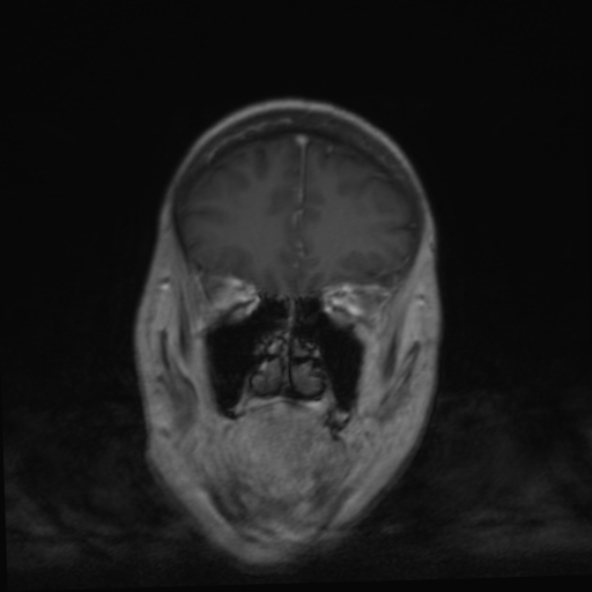File:Clival meningioma (Radiopaedia 53278-59248 F 8).jpg
