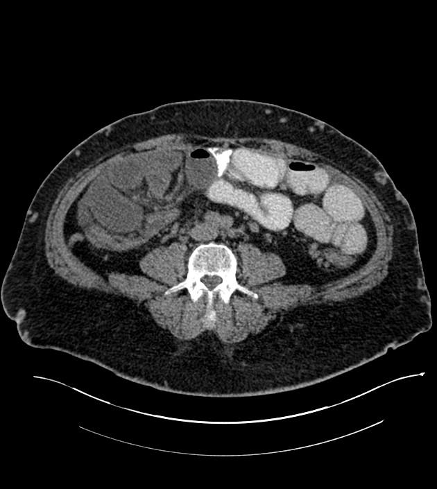 Closed-loop small bowel obstruction-internal hernia (Radiopaedia 78439-91096 Axial non-contrast 94).jpg