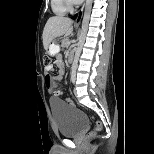 File:Closed-loop small bowel obstruction (Radiopaedia 73713-84509 B 91).jpg
