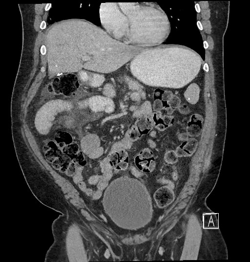 Closed loop obstruction - internal hernia into nephrectomy bed (Radiopaedia 59867-67320 B 49).jpg