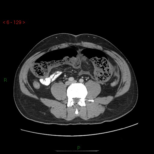 Closed loop obstruction and appendicular stump mucocele (Radiopaedia 54014-60163 A 74).jpg