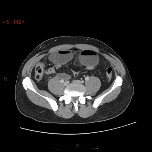 Closed loop obstruction and appendicular stump mucocele (Radiopaedia 54014-60163 A 83).jpg