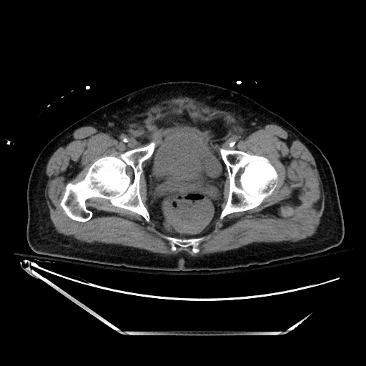 File:Closed loop obstruction due to adhesive band, resulting in small bowel ischemia and resection (Radiopaedia 83835-99023 Axial 86).jpg