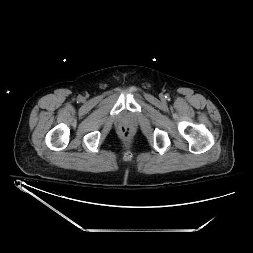 File:Closed loop obstruction due to adhesive band, resulting in small bowel ischemia and resection (Radiopaedia 83835-99023 Axial non-contrast 160).jpg