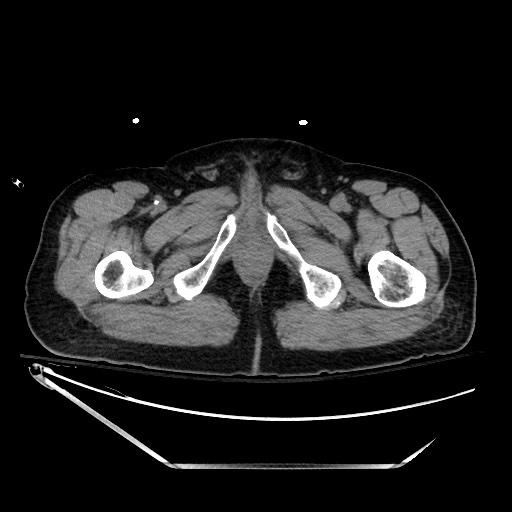File:Closed loop obstruction due to adhesive band, resulting in small bowel ischemia and resection (Radiopaedia 83835-99023 Axial non-contrast 166).jpg