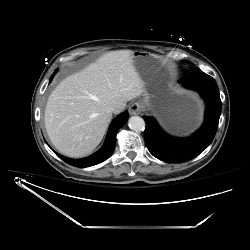 File:Closed loop obstruction due to adhesive band, resulting in small bowel ischemia and resection (Radiopaedia 83835-99023 D 30).jpg