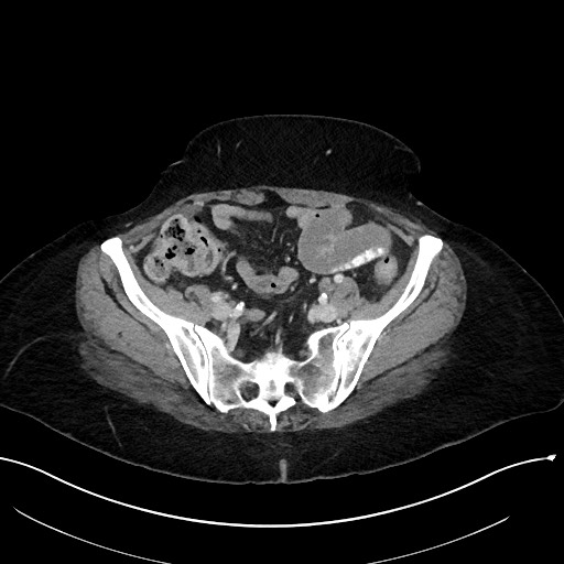 File:Closed loop small bowel obstruction - adhesions (Radiopaedia 59078-66369 A 98).jpg