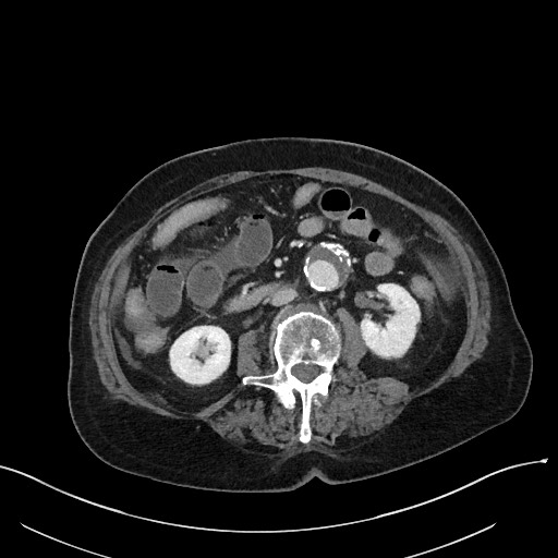 Closed loop small bowel obstruction - adhesions (Radiopaedia 59269-66611 A 65).jpg