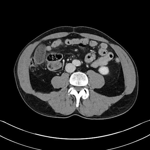 Closed loop small bowel obstruction - internal hernia (Radiopaedia 57806-64778 B 71).jpg