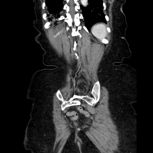 File:Closed loop small bowel obstruction due to adhesive band, with intramural hemorrhage and ischemia (Radiopaedia 83831-99017 C 106).jpg