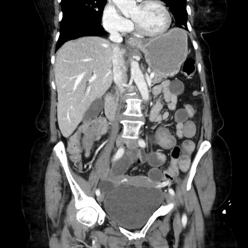 Closed loop small bowel obstruction due to adhesive band, with intramural hemorrhage and ischemia (Radiopaedia 83831-99017 C 60).jpg