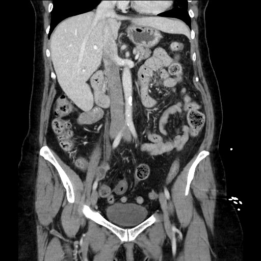 Closed loop small bowel obstruction due to adhesive bands - early and late images (Radiopaedia 83830-99014 B 59).jpg