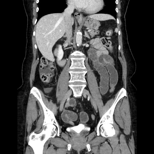 Closed loop small bowel obstruction due to adhesive bands - early and late images (Radiopaedia 83830-99015 B 68).jpg