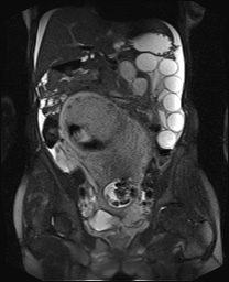File:Closed loop small bowel obstruction in pregnancy (MRI) (Radiopaedia 87637-104031 Coronal T2 fat sat 31).jpg