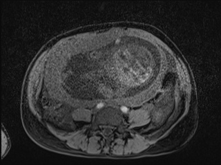 Closed loop small bowel obstruction in pregnancy (MRI) (Radiopaedia 87637-104031 F 21).jpg