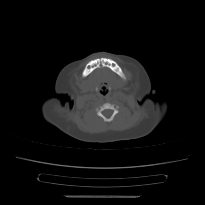 Cloverleaf skull (Radiopaedia 91901-109710 Axial bone window 23).jpg