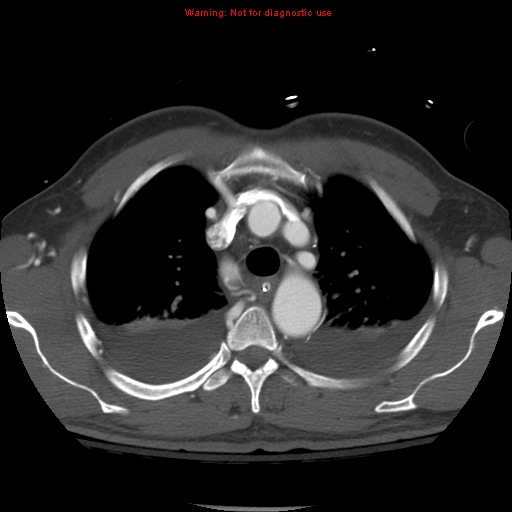 File:Coarctation of the aorta (Radiopaedia 8681-9490 B 20).jpg