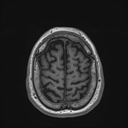 File:Cochlear incomplete partition type III associated with hypothalamic hamartoma (Radiopaedia 88756-105498 Axial T1 166).jpg