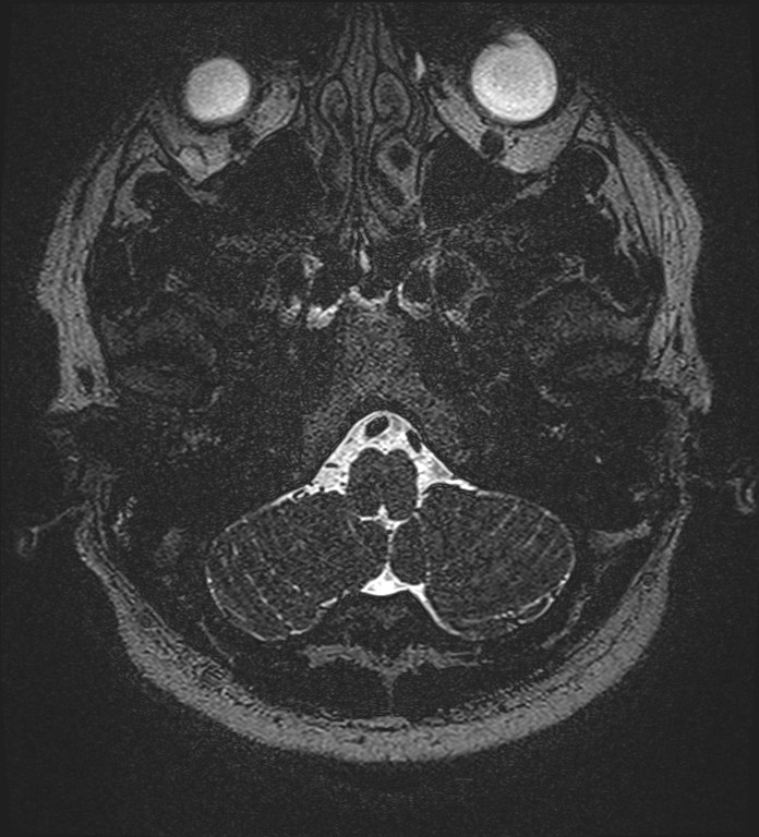 Cochlear incomplete partition type III associated with hypothalamic hamartoma (Radiopaedia 88756-105498 Axial T2 29).jpg