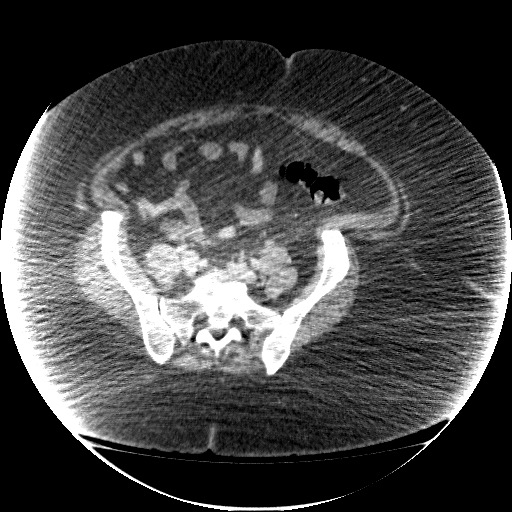 File:Collection due to leak after sleeve gastrectomy (Radiopaedia 55504-61972 A 60).jpg