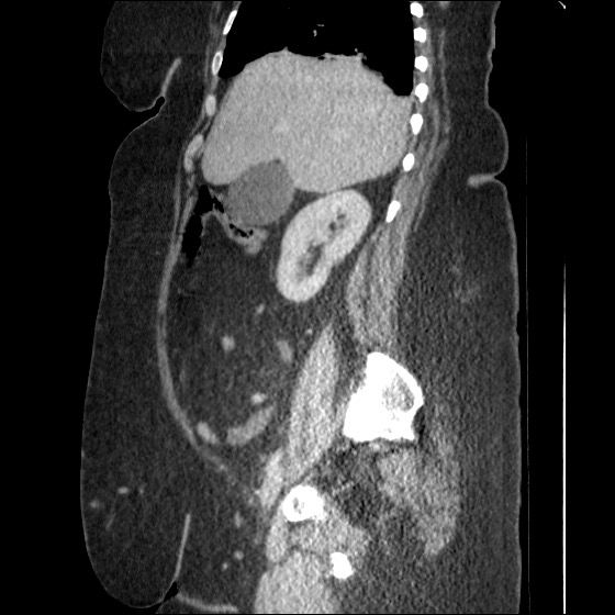 File:Collection due to leak after sleeve gastrectomy (Radiopaedia 55504-61972 C 44).jpg