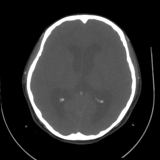 File:Colloid cyst (resulting in death) (Radiopaedia 33423-34499 A 30).png