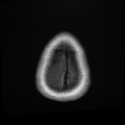 File:Colloid cyst with anterior communicating artery aneurysm (Radiopaedia 33901-35091 Axial T1 27).jpg