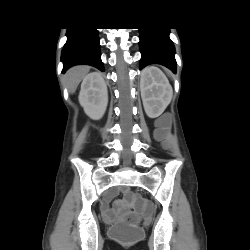 File:Colocolic fistula - Crohn disease (Radiopaedia 57063-63955 B 34).jpg