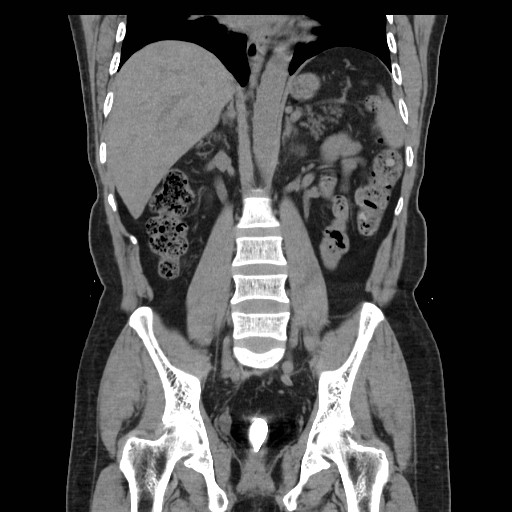 File:Colocutaneous fistula in Crohn's disease (Radiopaedia 29586-30093 E 26).jpg