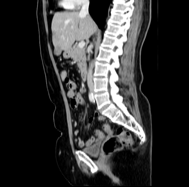 Colon carcinoma with hepatic metastases (Radiopaedia 29477-29961 C 26).jpg