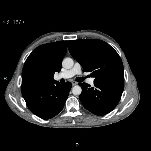 File:Colonic cancer (ultrasound and TC imaging) (Radiopaedia 50346-55713 B 167).jpg