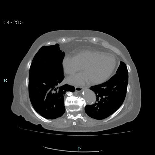 Colonic lipomas (Radiopaedia 49137-54244 Axial bone window 13).jpg