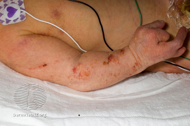 File:Focal dermal hypoplasia (Goltz syndrome) (DermNet NZ systemic-goltz1).jpg