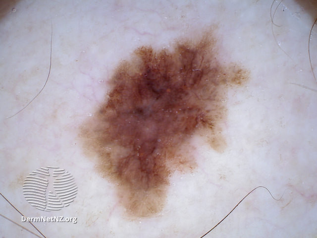 File:Melanoma in situ, nonpolarised dermoscopy view (DermNet NZ 20131210115606266).jpg
