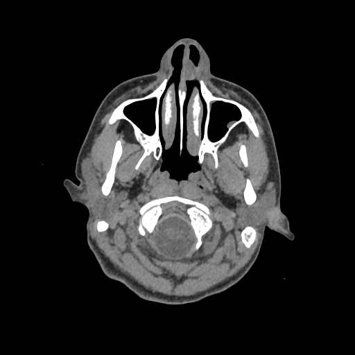Nasal pyogenic granuloma (lobular capillary hemangioma) (Radiopaedia 85536-101244 Axial non-contrast 22).jpg
