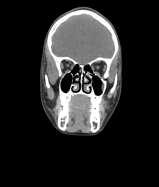 Nasal pyogenic granuloma (lobular capillary hemangioma) (Radiopaedia 85536-101244 Coronal non-contrast 91).jpg