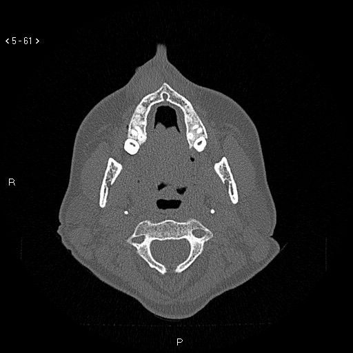 Nasolabial cyst (Radiopaedia 75125-86194 Axial bone window 22).jpg