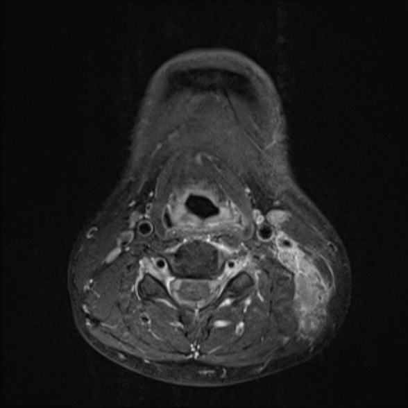 Nasopharyngeal carcinoma with skull base invasion (Radiopaedia 53415-59485 Axial T1 C+ fat sat 53).jpg