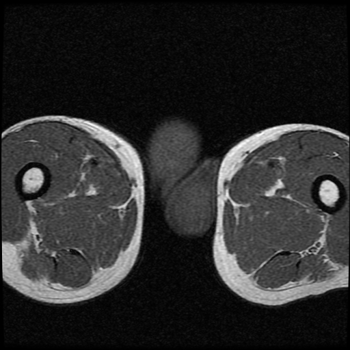 File:Necrotizing epididymo-orchitis with intra-testicular abscess (Radiopaedia 29397-29860 Axial T1 17).jpg