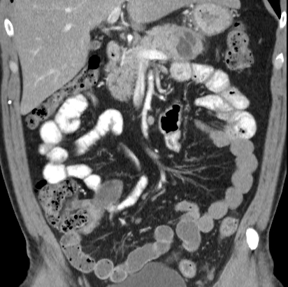 File:Necrotizing pancreatitis with acute necrotic collection (Radiopaedia 14470-14417 C 14).jpg