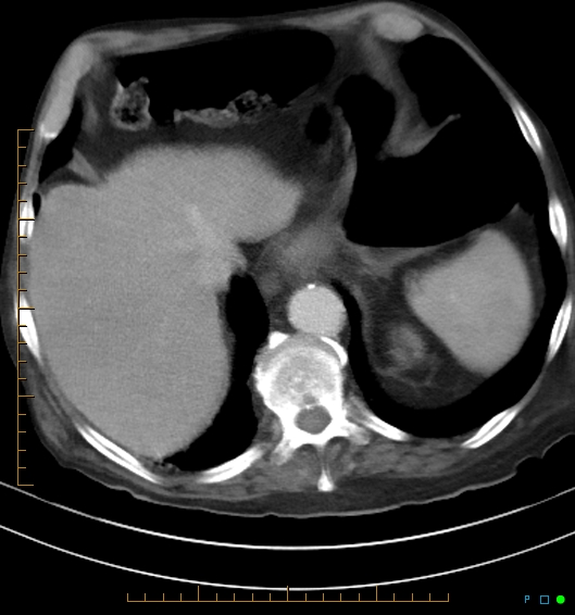 Necrotzing fasciitis due to a perforated adenocarcinoma of the splenic flexure (Radiopaedia 46930-51455 A 17).jpg