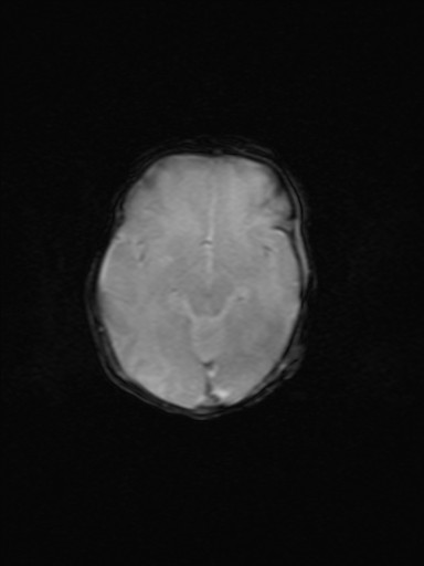 File:Neonatal hypoxic-ischemic encephalopathy (Radiopaedia 41406-44277 Axial Gradient Echo 12).jpg