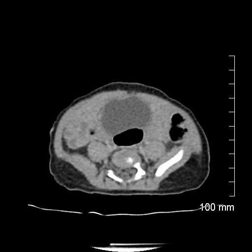 File:Neonatal neuroblastoma (Radiopaedia 56651-63438 Axial non-contrast 59).jpg